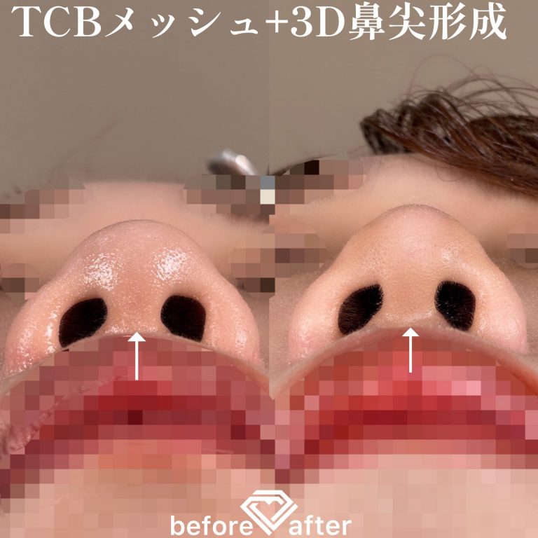 TCBメッシュ(担当医:森本 理一郎 医師)の症例写真4
