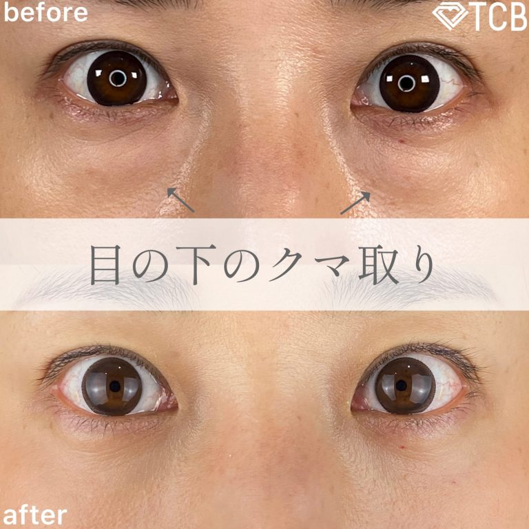 切らない目の下のクマ取り・目の下のたるみ（ふくらみ）取り(担当医:TCB 医師)の症例写真1