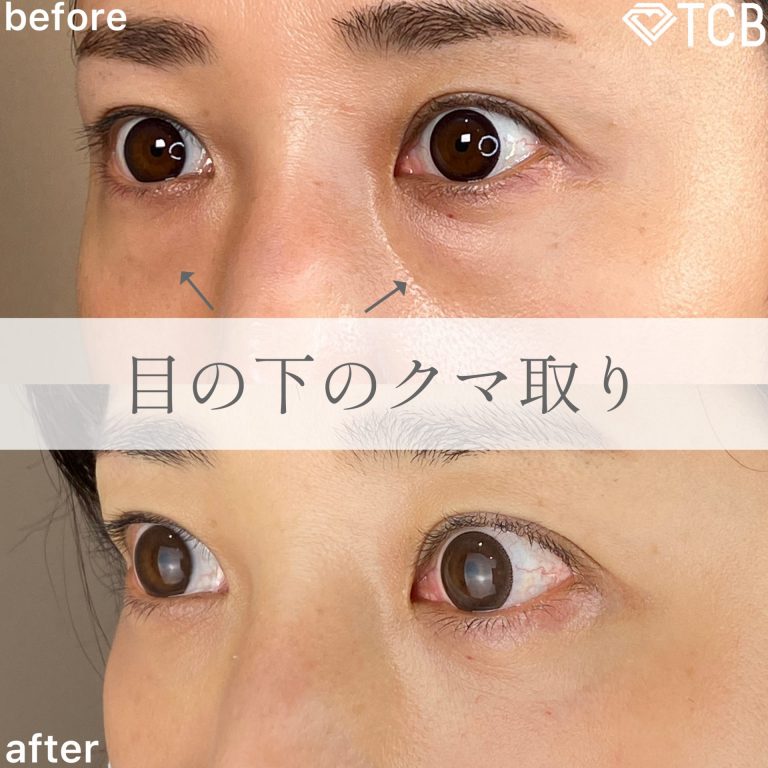 切らない目の下のクマ取り・目の下のたるみ（ふくらみ）取り(担当医:TCB 医師)の症例写真2