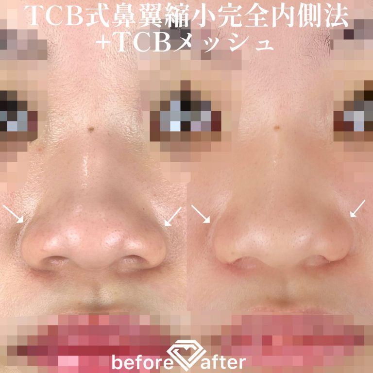 TCBメッシュ(担当医:森本 理一郎 医師)の症例写真1