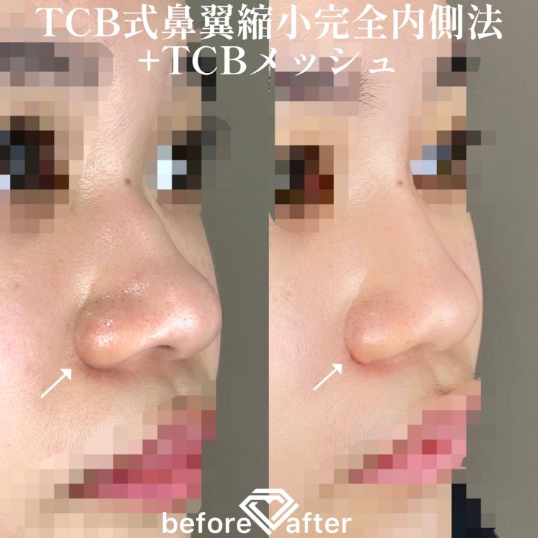 TCBメッシュ(担当医:TCB 医師)の症例写真2