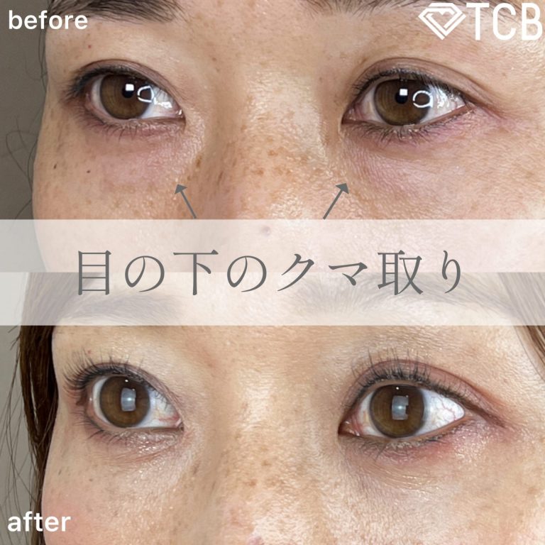 切らない目の下のクマ取り・目の下のたるみ（ふくらみ）取り(担当医:TCB 医師)の症例写真2