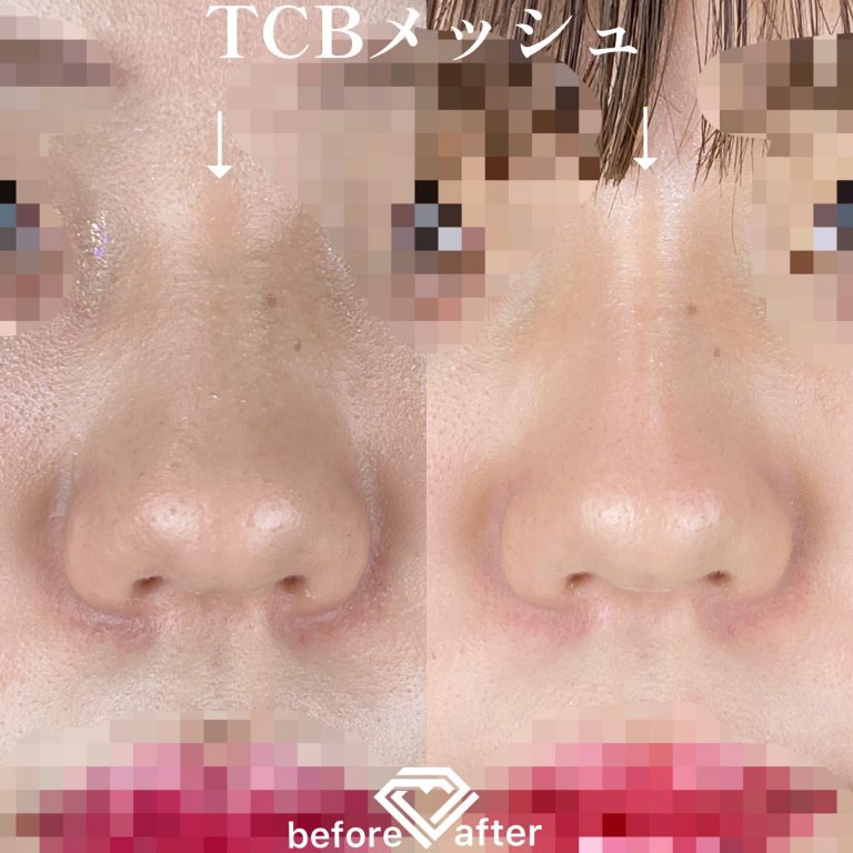 TCBメッシュ(担当医:TCB 医師)の症例写真1