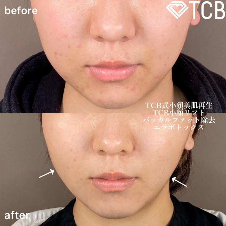 TCB式小顔美肌再生(担当医:森本 理一郎 医師)の症例写真1