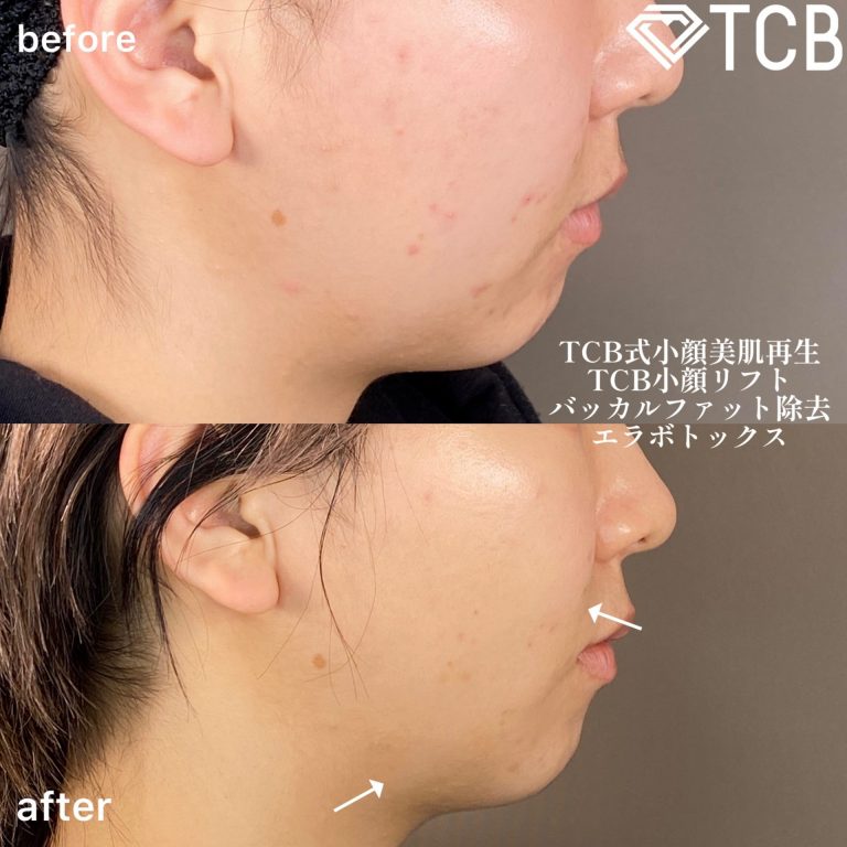 TCB式小顔美肌再生(担当医:森本 理一郎 医師)の症例写真3