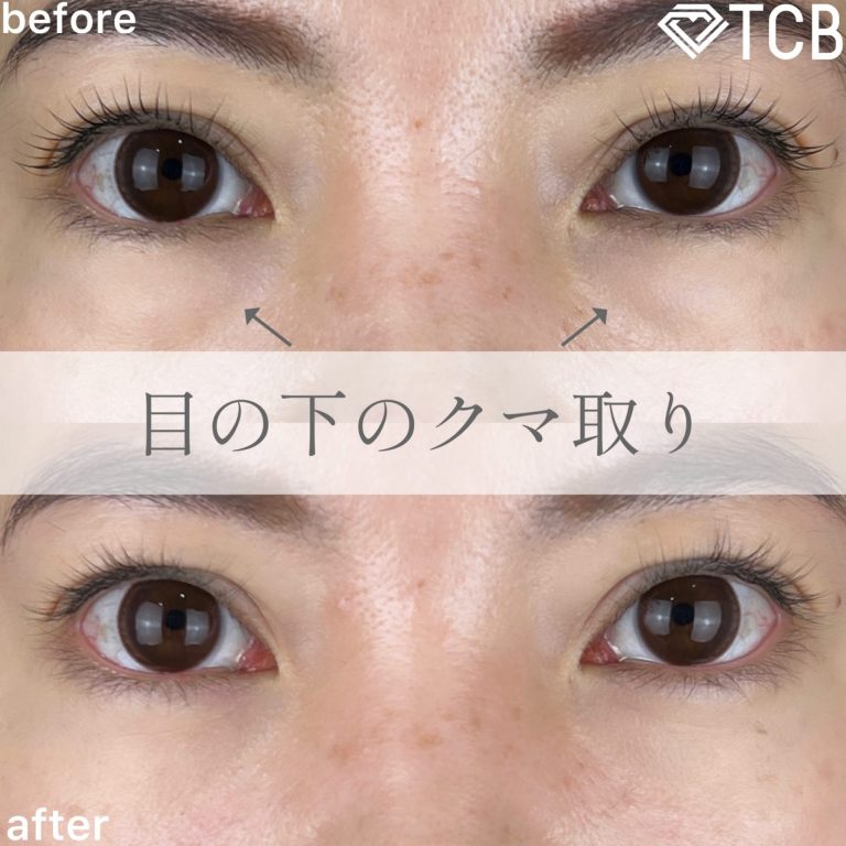 切らない目の下のクマ取り・目の下のたるみ（ふくらみ）取り(担当医:TCB 医師)の症例写真1