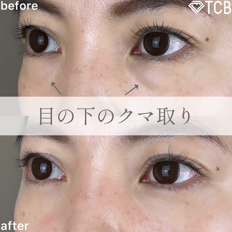 切らない目の下のクマ取り・目の下のたるみ（ふくらみ）取り(担当医:TCB 医師)の症例写真2