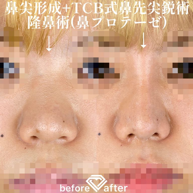 TCB式鼻先尖鋭術（だんご鼻解消）(担当医:森本 理一郎 医師)の症例写真1