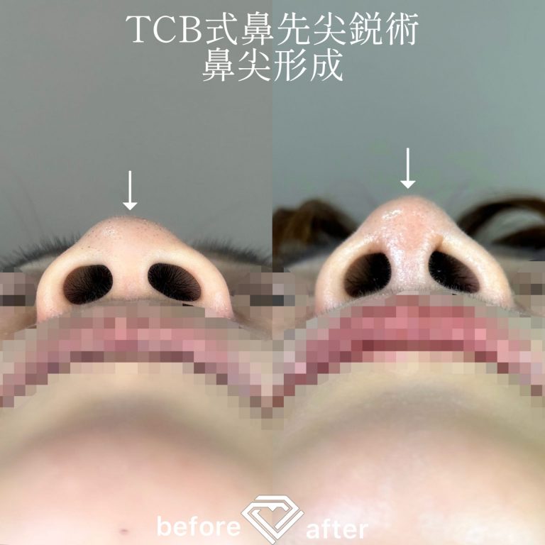 TCB式鼻先尖鋭術（だんご鼻解消）(担当医:TCB 医師)の症例写真4