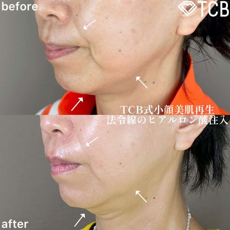 小顔美肌再生（リフトアップ）(担当医:TCB 医師)の症例写真2