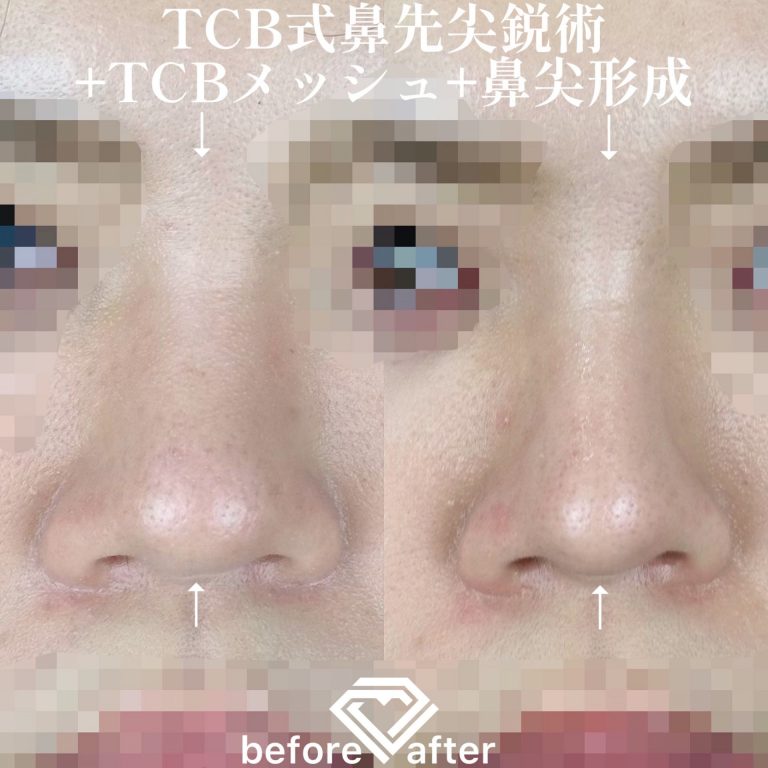 TCB式鼻先尖鋭術（だんご鼻解消）(担当医:TCB 医師)の症例写真1