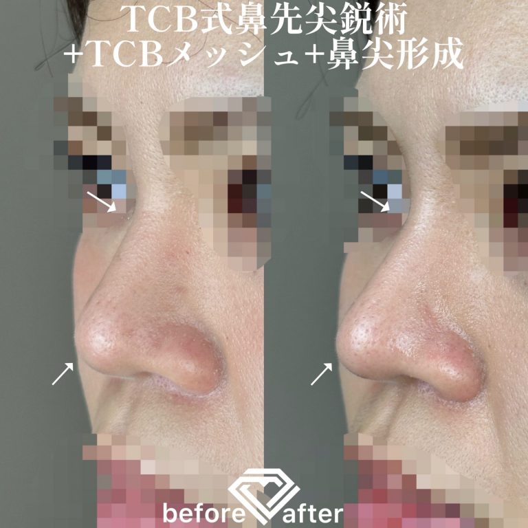 TCB式鼻先尖鋭術（だんご鼻解消）(担当医:TCB 医師)の症例写真2