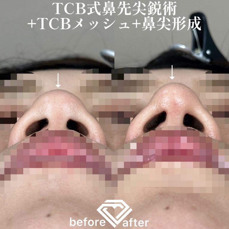 TCB式鼻先尖鋭術（だんご鼻解消）(担当医:TCB 医師)の症例写真3