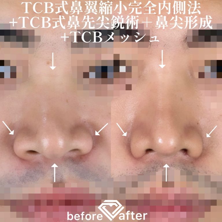 TCBメッシュ(担当医:TCB 医師)の症例写真1