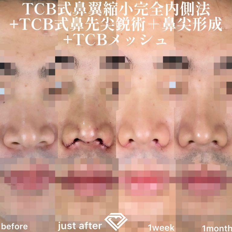 TCBメッシュ(担当医:TCB 医師)の症例写真2