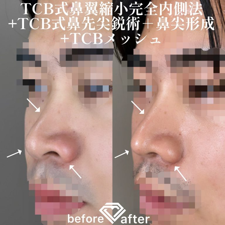 TCBメッシュ(担当医:TCB 医師)の症例写真3