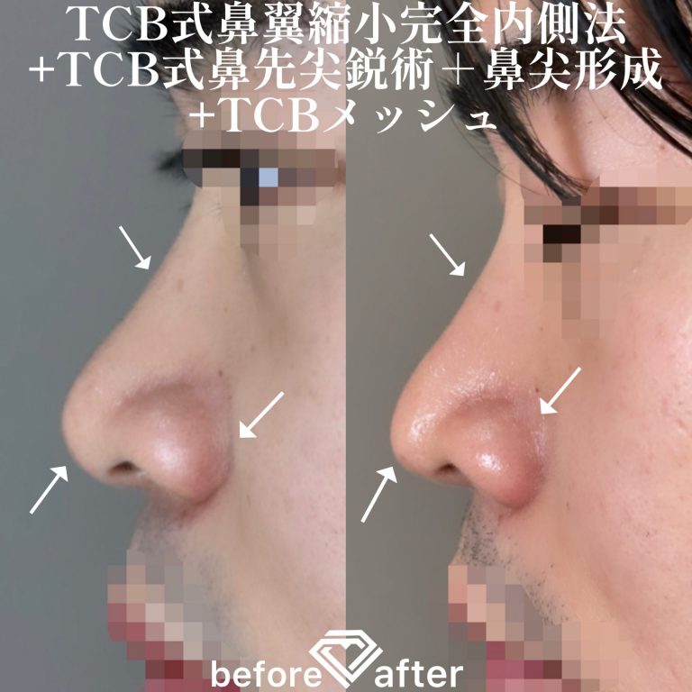 TCBメッシュ(担当医:TCB 医師)の症例写真4