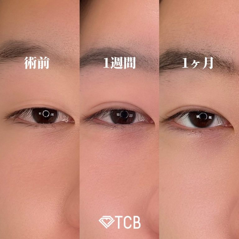 二重埋没法(担当医:TCB 医師)の症例写真1