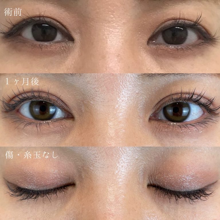 二重埋没法(担当医:TCB 医師)の症例写真1