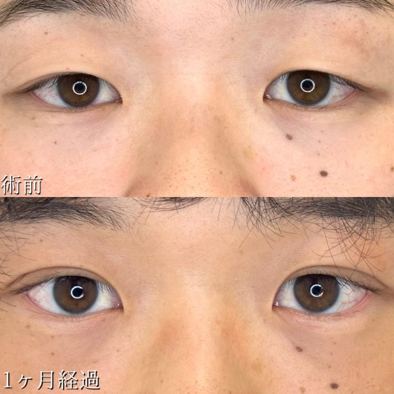 二重埋没法(担当医:TCB 医師)の症例写真1