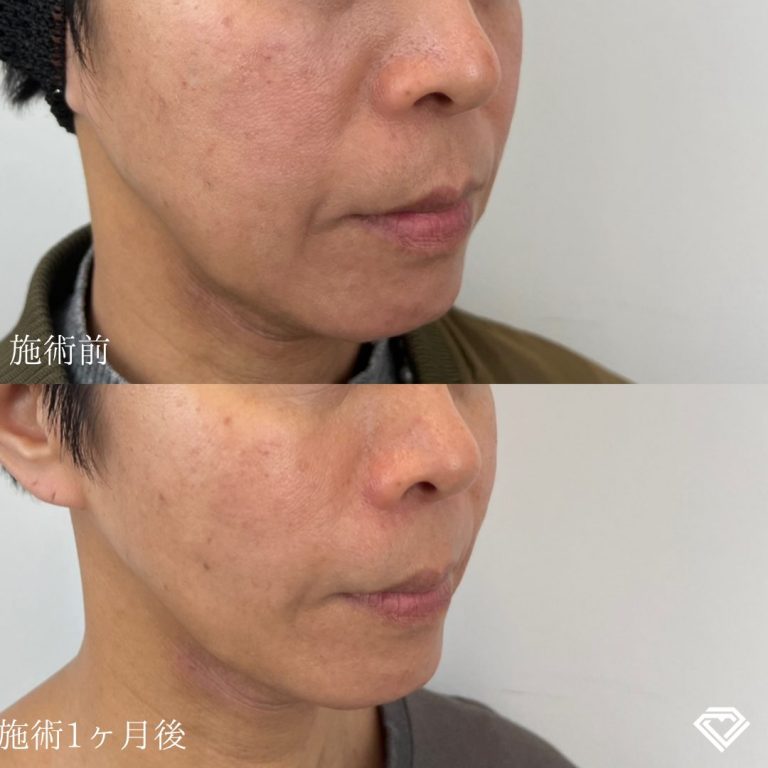 TCB式小顔美肌再生(担当医:山崎 智徳 医師)の症例写真1