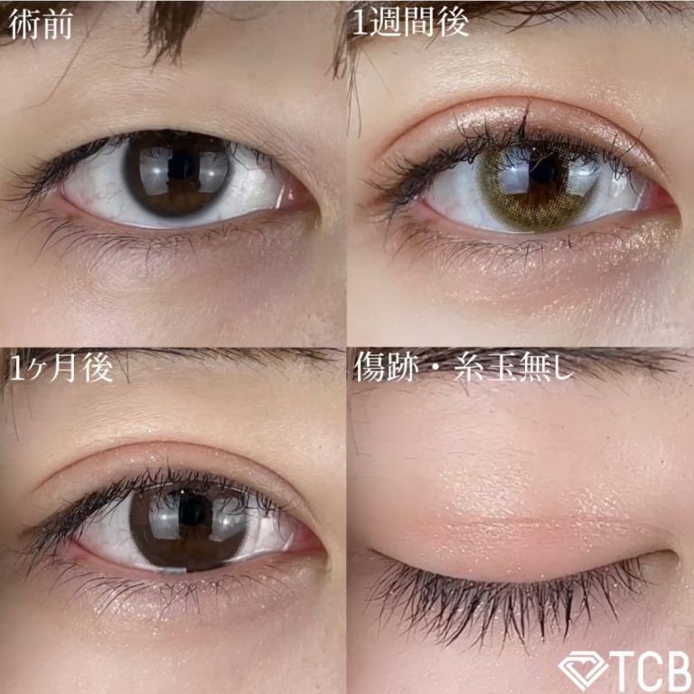 二重埋没法(担当医:TCB 医師)の症例写真1