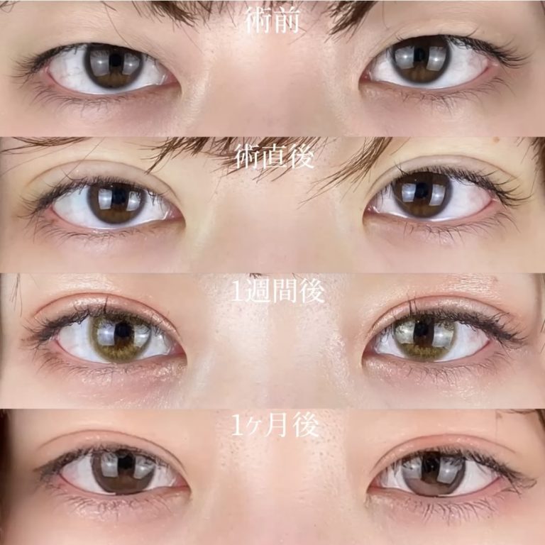 二重埋没法(担当医:TCB 医師)の症例写真2