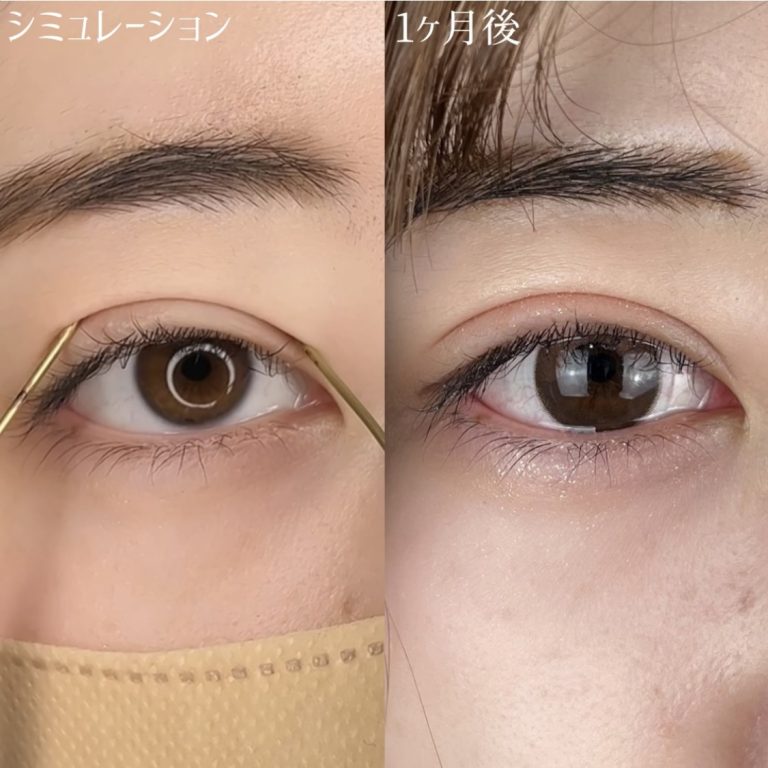 二重埋没法(担当医:TCB 医師)の症例写真3