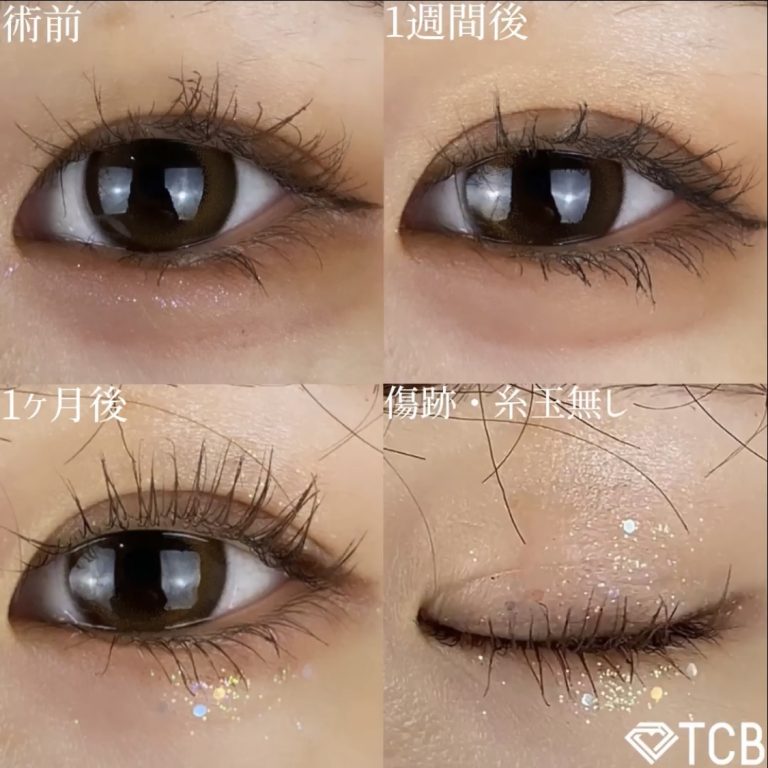 二重埋没法(担当医:TCB 医師)の症例写真1