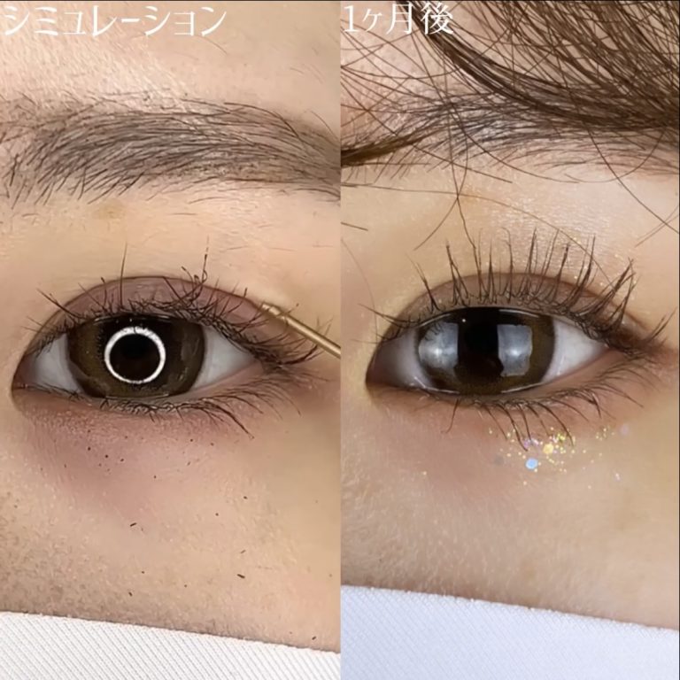 二重埋没法(担当医:TCB 医師)の症例写真2