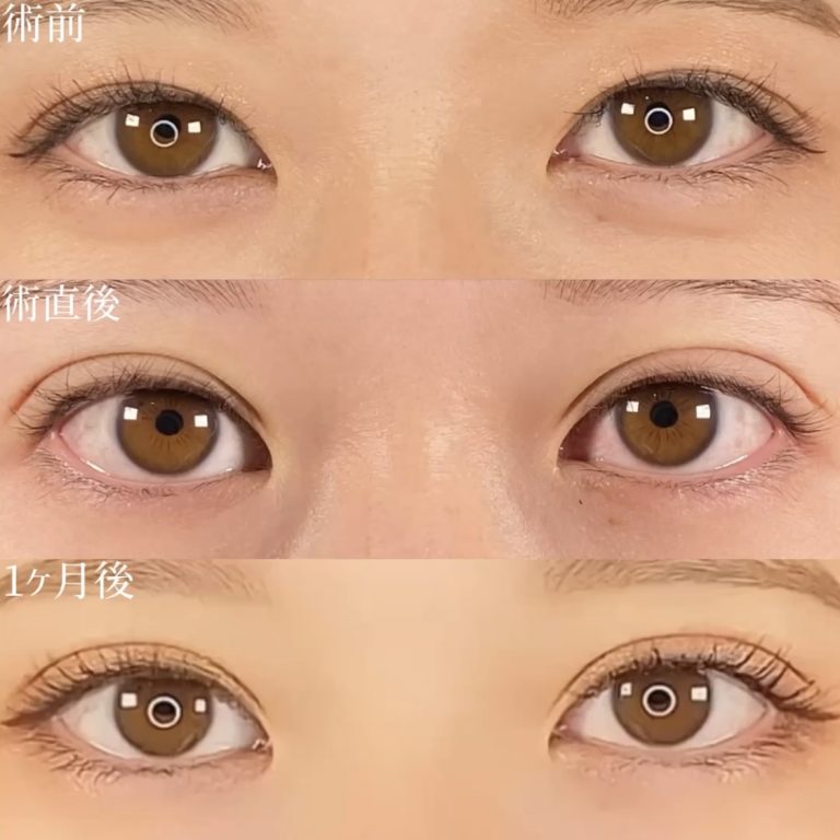 二重埋没法(担当医:TCB 医師)の症例写真2