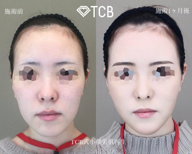 TCB式小顔美肌再生(担当医:寺西 宏王 医師)の症例写真1