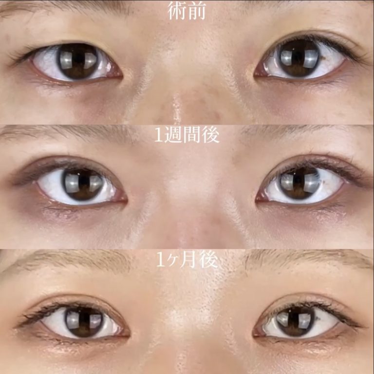 二重埋没法(担当医:TCB 医師)の症例写真2
