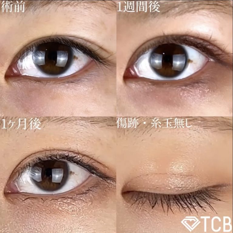 二重埋没法(担当医:TCB 医師)の症例写真1