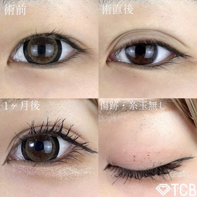 二重埋没法(担当医:TCB 医師)の症例写真1