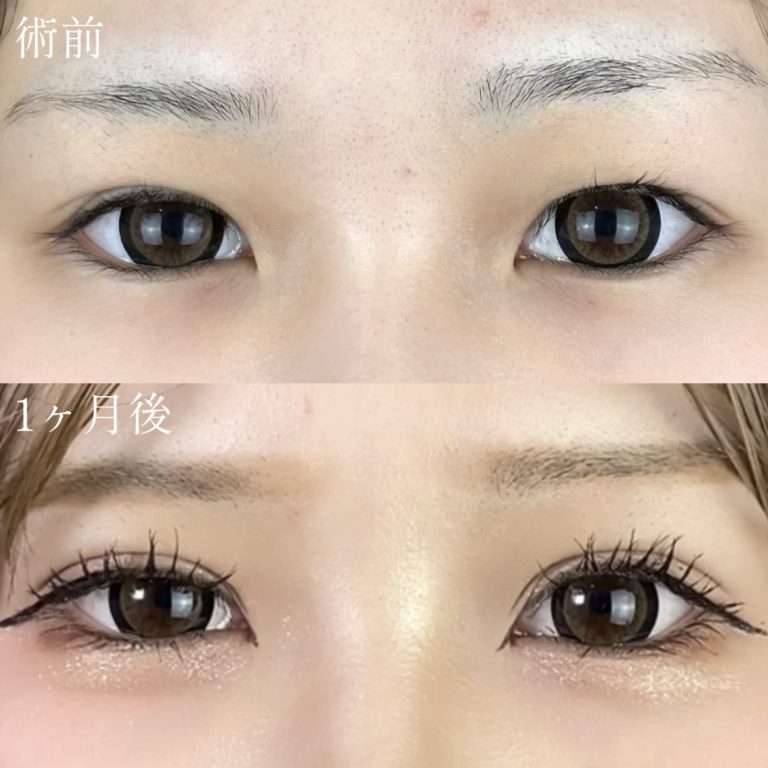 二重埋没法(担当医:TCB 医師)の症例写真2
