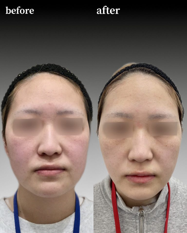 TCB式小顔脂肪吸引(担当医:奥村 公貴 医師)の症例写真1