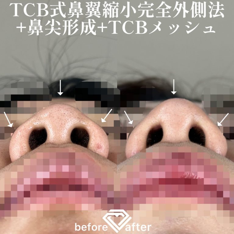 TCBメッシュ(担当医:TCB 医師)の症例写真4