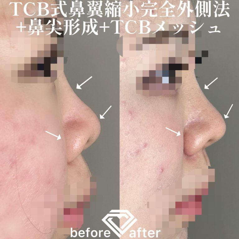 TCBメッシュ(担当医:TCB 医師)の症例写真3