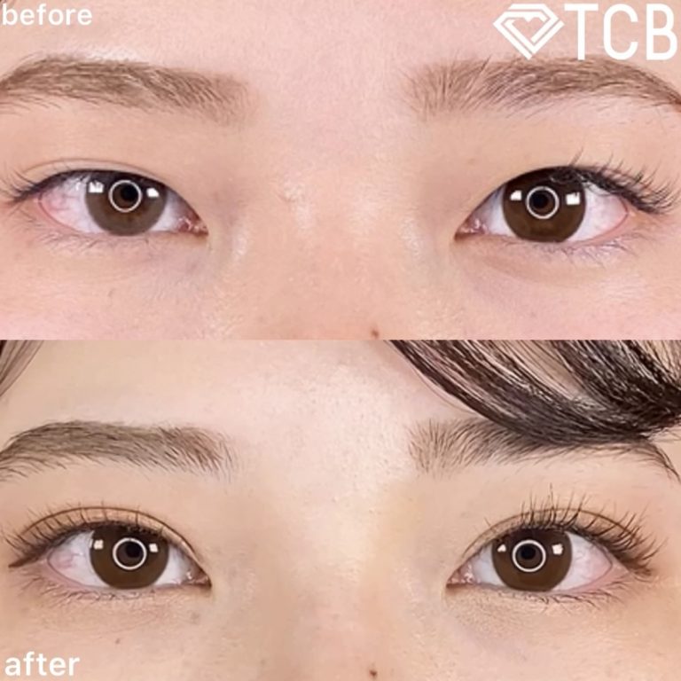 二重埋没法(担当医:TCB 医師)の症例写真1