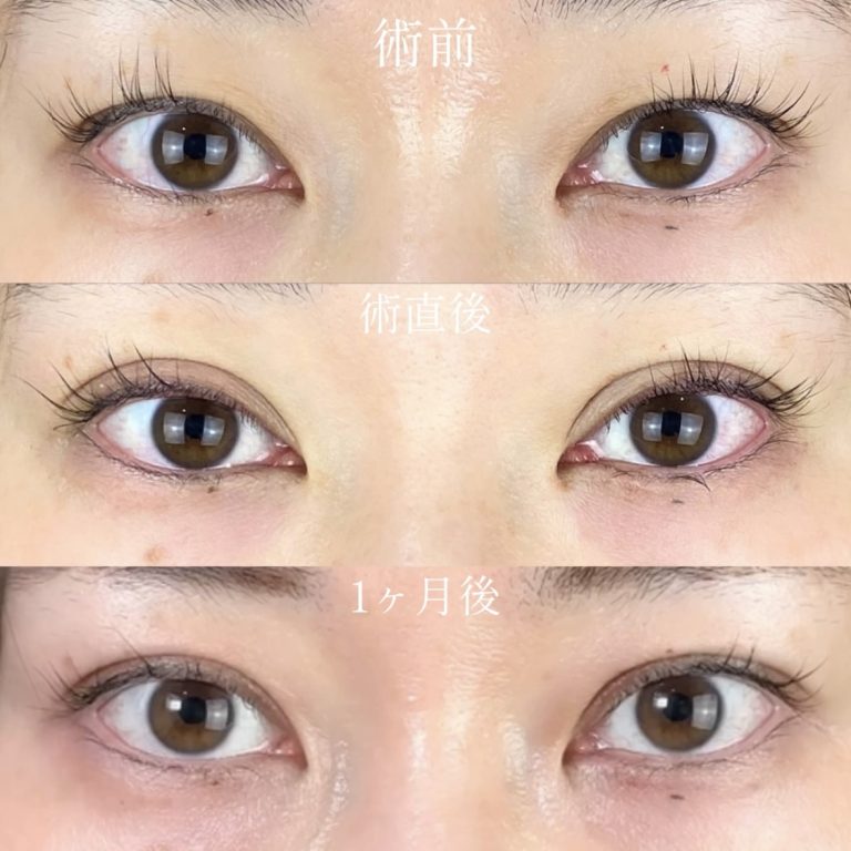 二重埋没法(担当医:TCB 医師)の症例写真2