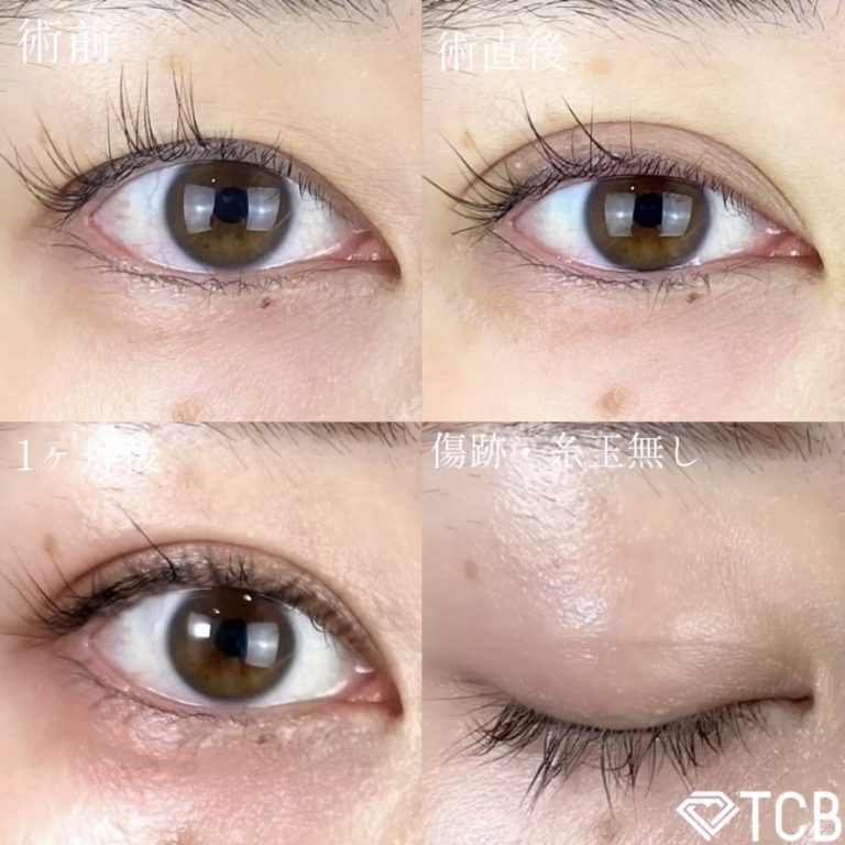 二重埋没法(担当医:TCB 医師)の症例写真1