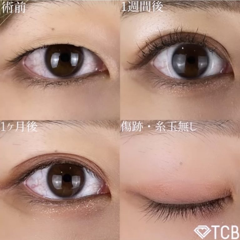 二重埋没法(担当医:TCB 医師)の症例写真1