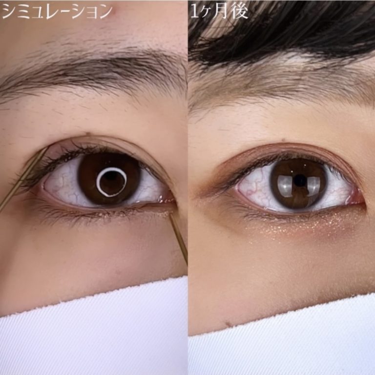 二重埋没法(担当医:TCB 医師)の症例写真2