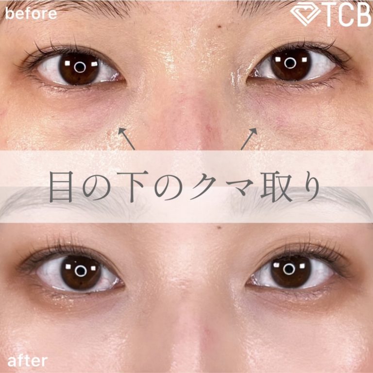 切らない目の下のクマ取り・目の下のたるみ（ふくらみ）取り(担当医:TCB 医師)の症例写真1