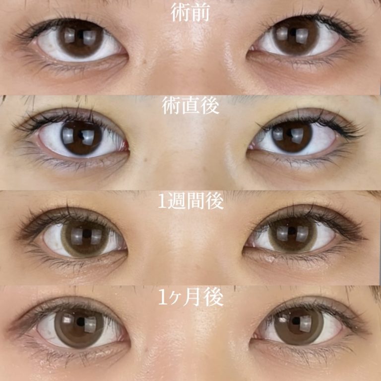 二重埋没法(担当医:TCB 医師)の症例写真2