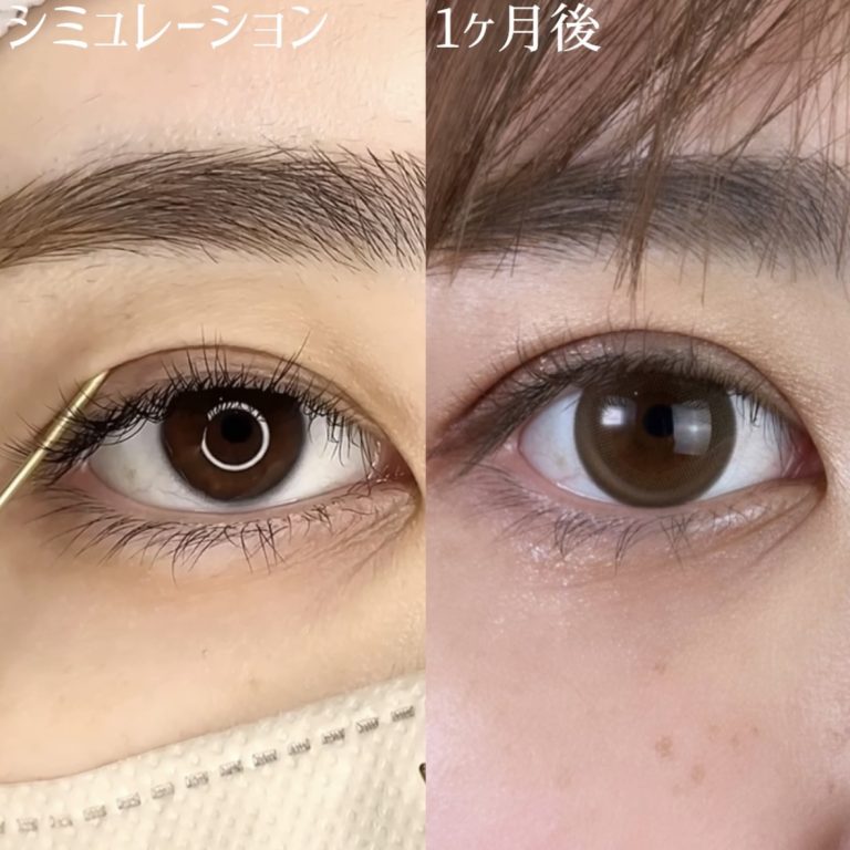 二重埋没法(担当医:TCB 医師)の症例写真3