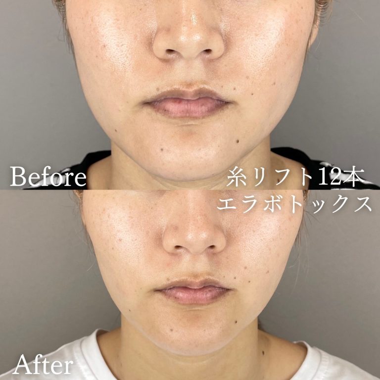 小顔美肌再生（リフトアップ）(担当医:TCB 医師)の症例写真1