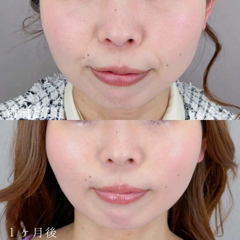 小顔美肌再生（リフトアップ）(担当医:TCB 医師)の症例写真1