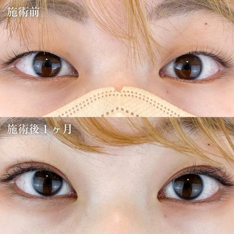 二重埋没法(担当医:TCB 医師)の症例写真1